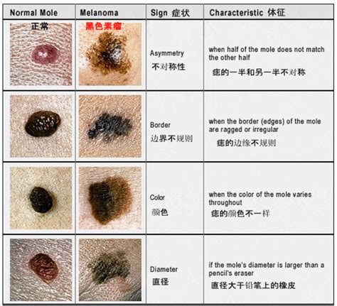 痣變大變凸|痣增大且凸起，是否需要手術切除？